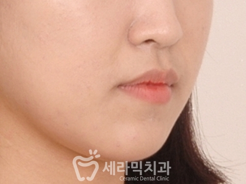 돌출입교정으로 갸름한 턱라인까지 되찾다! 돌출입 치아교정전후 관련 이미지 7