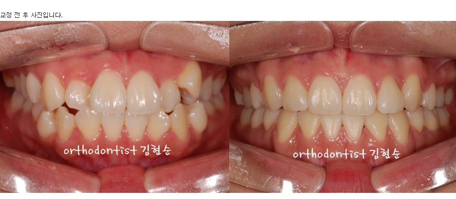세라믹교정 은 세라믹치과 수술없이 돌출개선 관련 이미지 7