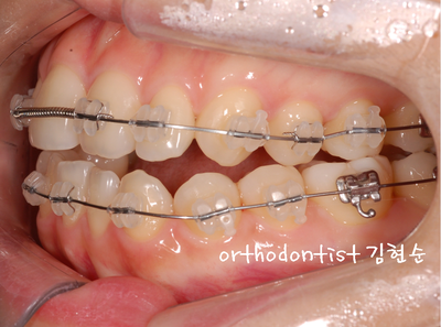 개방 교합 관련 이미지 20