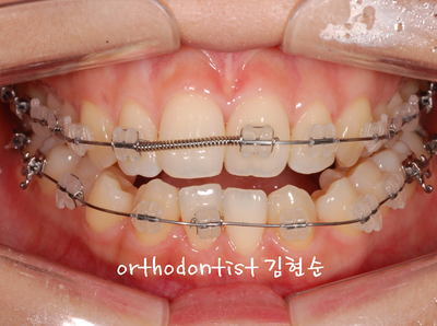 개방 교합 관련 이미지 15