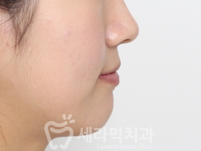 앞니 돌출, 나비치아를 남몰래 해결한 치아교정 전후! 관련 이미지 23