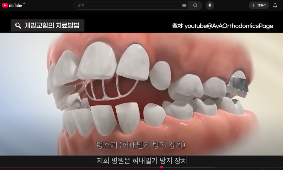 '개방교합' 치료법과 근본적인 해결방법 (feat. 비수술 치아교정) 관련 이미지 5