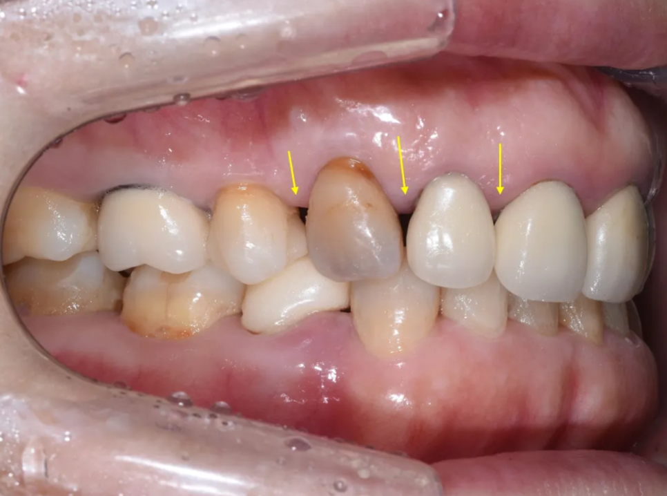 일본에서 거절당했던 앞니 심미보철 크라운 관련 이미지 6