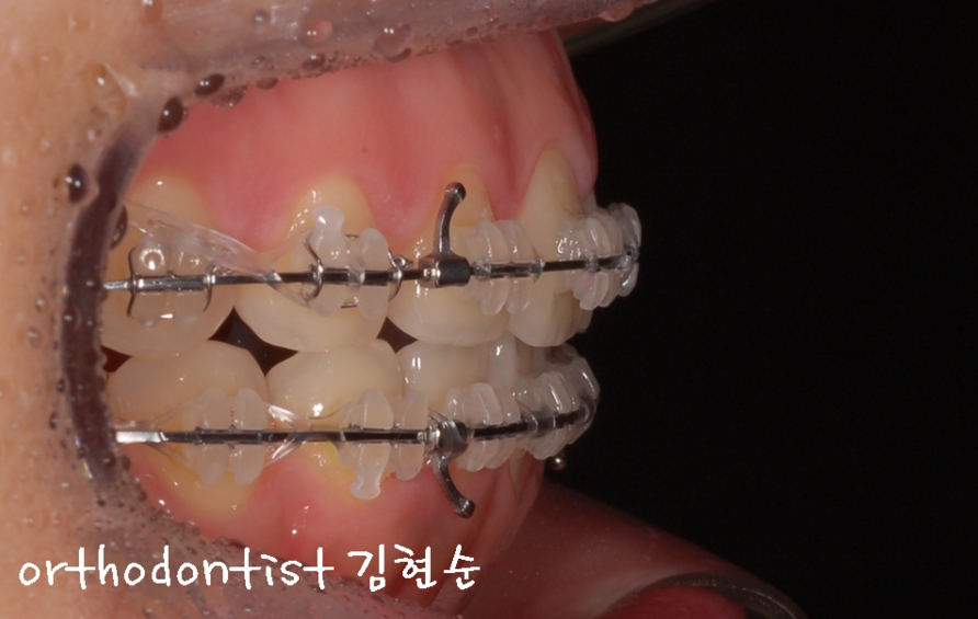 세라믹교정 은 세라믹치과 돌출입교정 관련 이미지 9