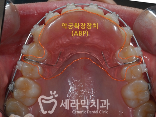 청소년교정 10대교정 딥바이트 과개교합 치아교정전후 관련 이미지 7