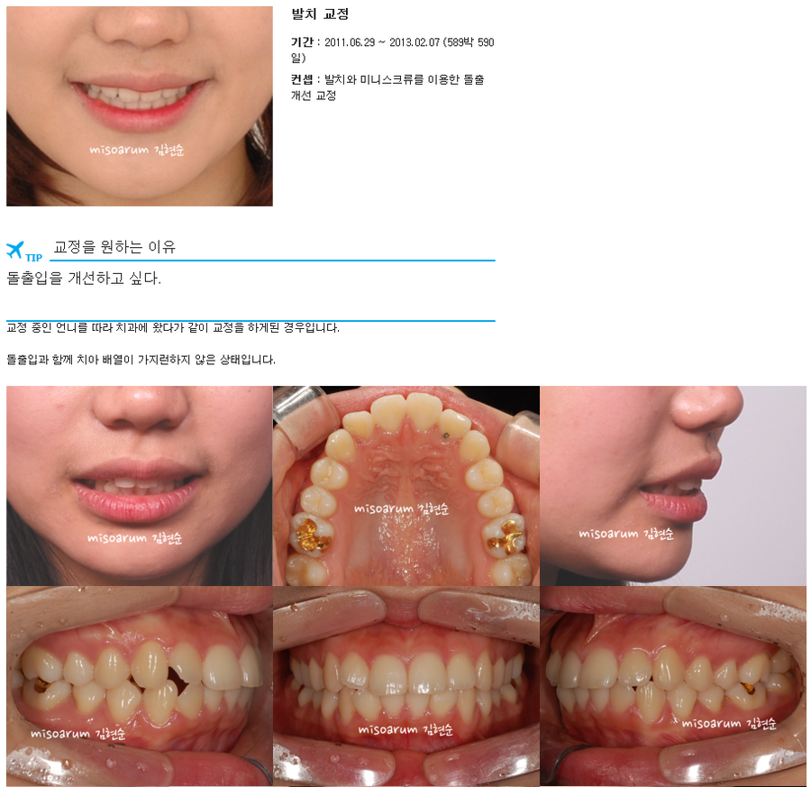 세라믹교정 세라믹치과-돌출입발치교정 9 관련 이미지 1