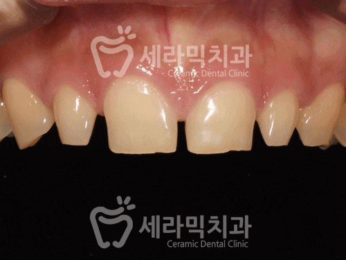 벌어진 앞니, 최소삭제 라미네이트 전후 관련 이미지 4