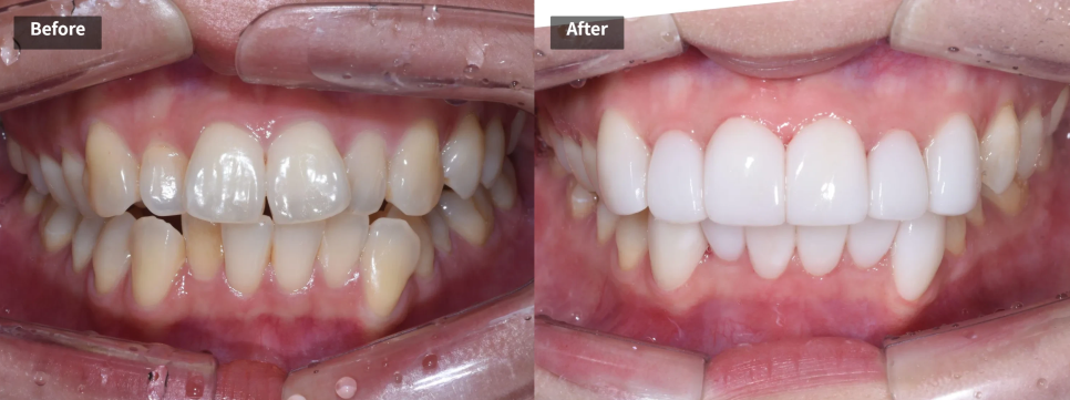 세라믹 치과, 삐뚤빼뚤한 치아를 교정 없이 라미네이트로 치료한 사례 관련 이미지 6
