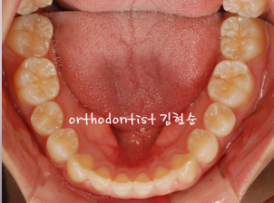 강남 돌출입 교정 관련 이미지 9