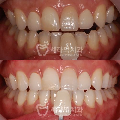 연말 치아미백 이벤트 , 학동역 세라믹치과 관련 이미지 6