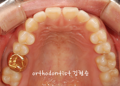 치열 교정 ( 벌어짐 ) 관련 이미지 7