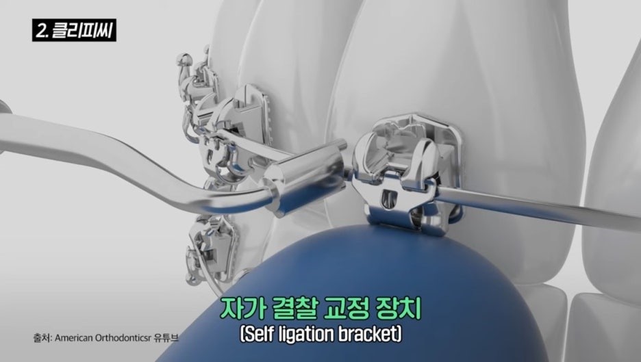 How to Choose an Orthodontic Appliance Without Regret image 5