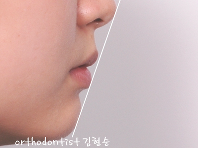 강남 돌출 (토끼 치아) 관련 이미지 11