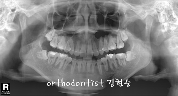 강남 돌출 (토끼 치아) 관련 이미지 35