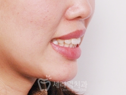 돌출입교정만 했을 뿐인데, 성형한 것처럼 달라진 인상! 관련 이미지 5