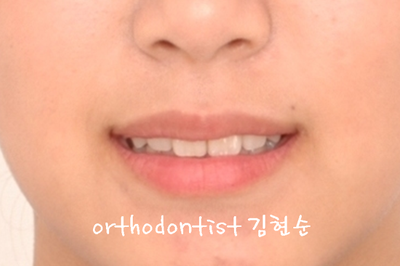 강남 덧니 관련 이미지 29