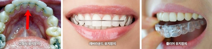 세라믹교정 가격 4대부작용 관련 이미지 10