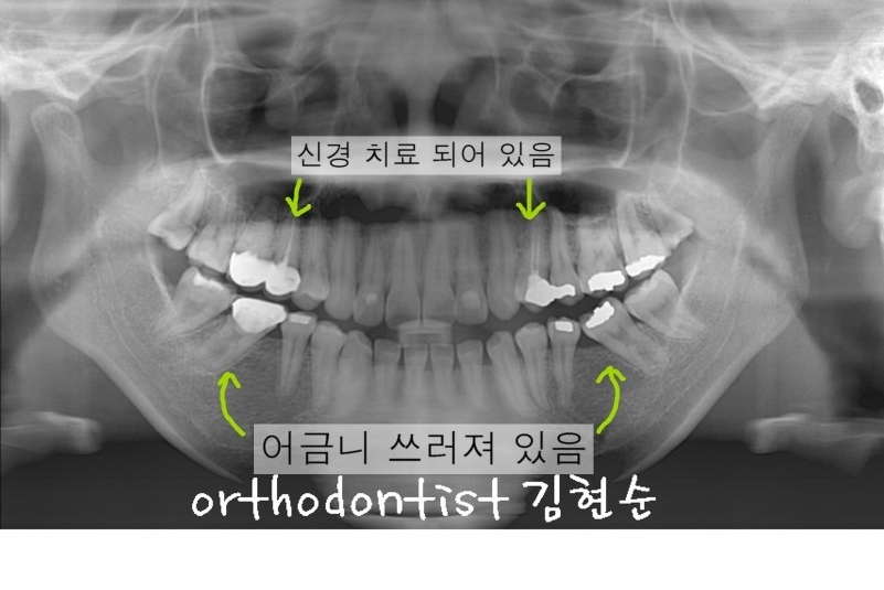 세라믹교정 은 세라믹치과 돌출입교정 관련 이미지 6