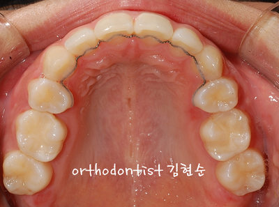 강남 돌출 관련 이미지 24