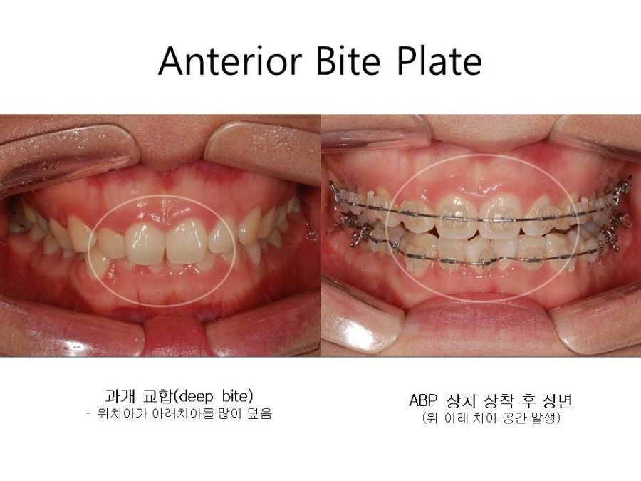 학동역치과 치아교정 잘하는 곳 ! 관련 이미지 11