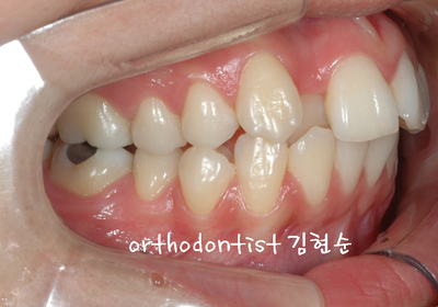 강남 돌출 관련 이미지 6