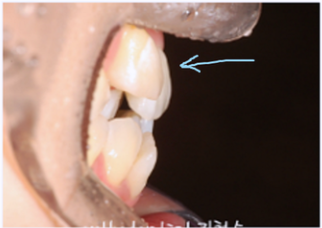 강남 덧니 관련 이미지 4