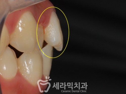 돌출입, 치열불규칙, 치아상실 치아교정과 임플란트 전후 관련 이미지 2