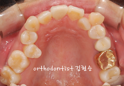강남 덧니, 돌출 관련 이미지 6