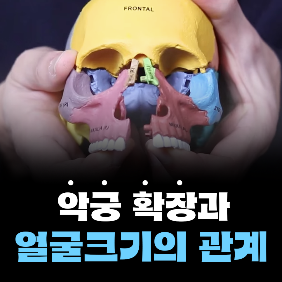 강남치아교정, 악궁확장하면 얼굴크기 커질까? 관련 이미지 1