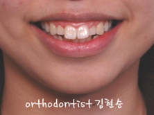 미니스크류, 돌출입 발치 교정 잇몸노출 개선 관련 이미지 1