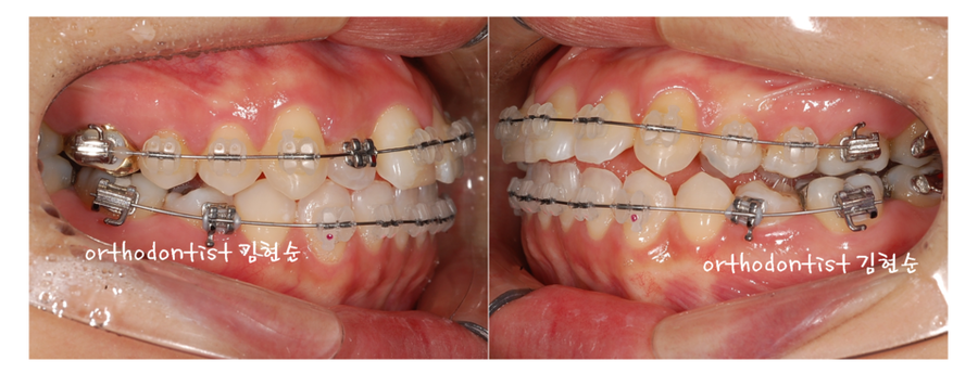 안면비대칭 교정, 치아교정만으로 간단히 해결하기 관련 이미지 11