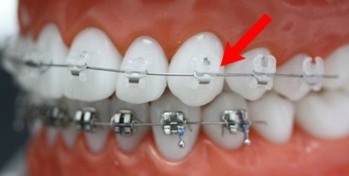 학동역치아교정치과 미소가아름다운치과의 교정창지 관련 이미지 2