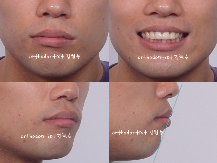 세라믹교정 세라믹치과-돌출입발치교정 1 관련 이미지 3