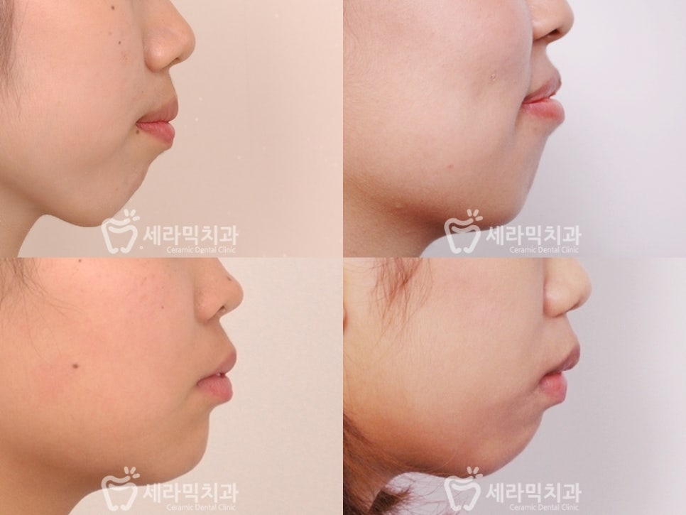 돌출입 치아교정을 통해, 매력적인 옆 라인으로 변신! 관련 이미지 1