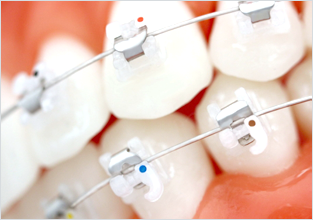 세라믹교정 세라믹치과 클리피씨교정 이야기 관련 이미지 6