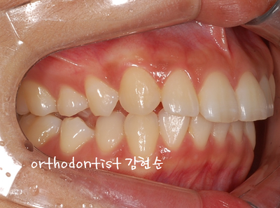 돌출 교정 (비발치 교정/비대칭) 관련 이미지 7