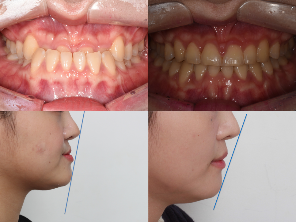 언주역 치과, 주걱턱 + 과개교합을 비수술로 치료한 사례 관련 이미지 1