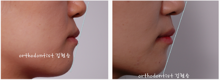강남 덧니 관련 이미지 18