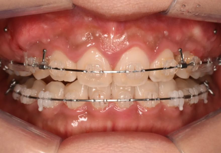 과개교합 교정: 비수술로 치료한 토끼 이빨 이야기 관련 이미지 9