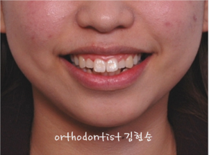 강남 돌출입 교정 관련 이미지 3