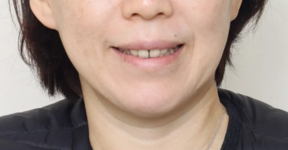 일본에서 거절당했던 앞니 심미보철 크라운 관련 이미지 3