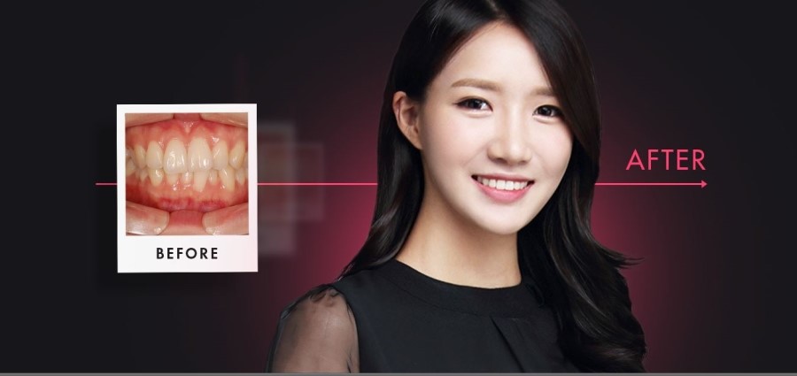 세라믹교정 세라믹치과 - 교정후기 관련 이미지 2