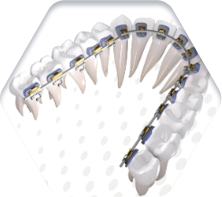 세라믹교정 세라믹치과 - 콤비네이션 교정이란 ? 관련 이미지 7