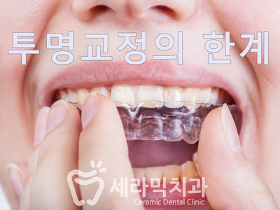 투명치아교정 부작용과 부실 진료? 관련 이미지 5