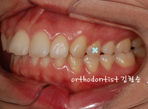 강남 돌출입 교정 관련 이미지 27