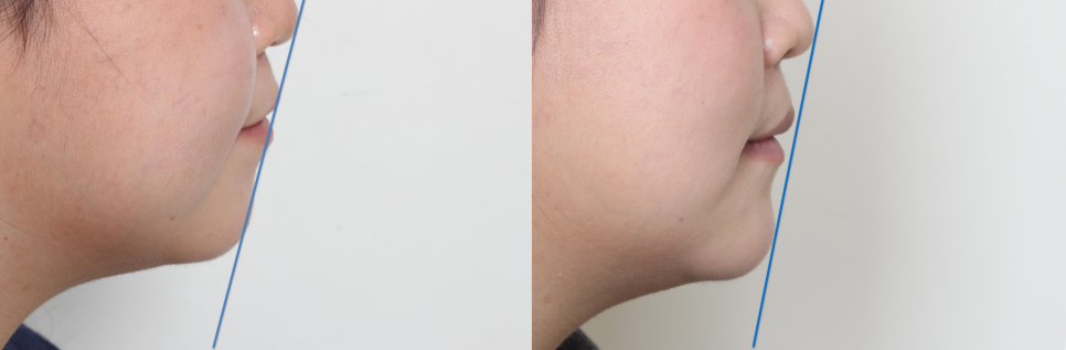 학동역 교정치과, 개방교합과 비대칭을 수술없이 교정한 경우 관련 이미지 12