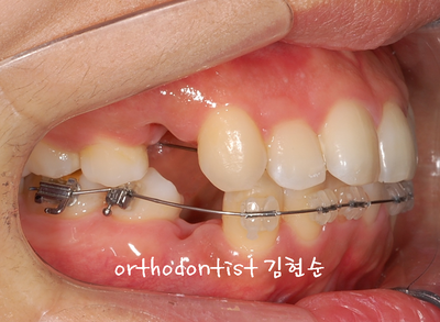 강남 돌출 관련 이미지 19