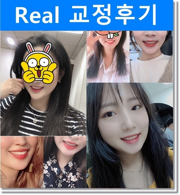 벌어진치아 투명교정 치아교정전후 관련 이미지 6