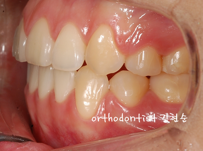 치열 교정(치열 불규칙) 관련 이미지 29