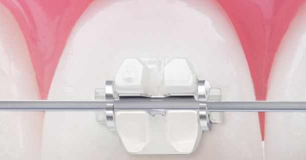 학동역치과 세라믹교정 특징은? 관련 이미지 3